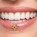 Sorriso com dentes brancos evidenciando proibição de fita clareadora pela Anvisa.